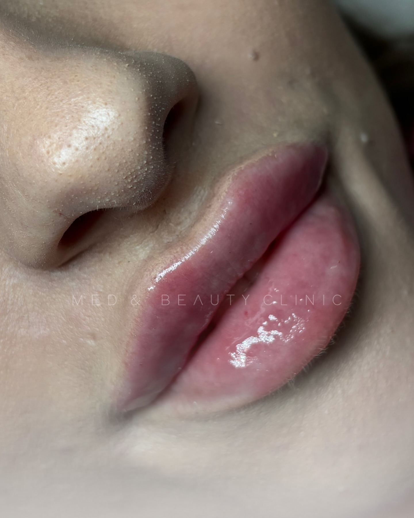 Modelowanie ust – precyzja i naturalność